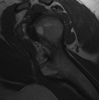Figure 4 for case osteochondroma ( RID4136 )